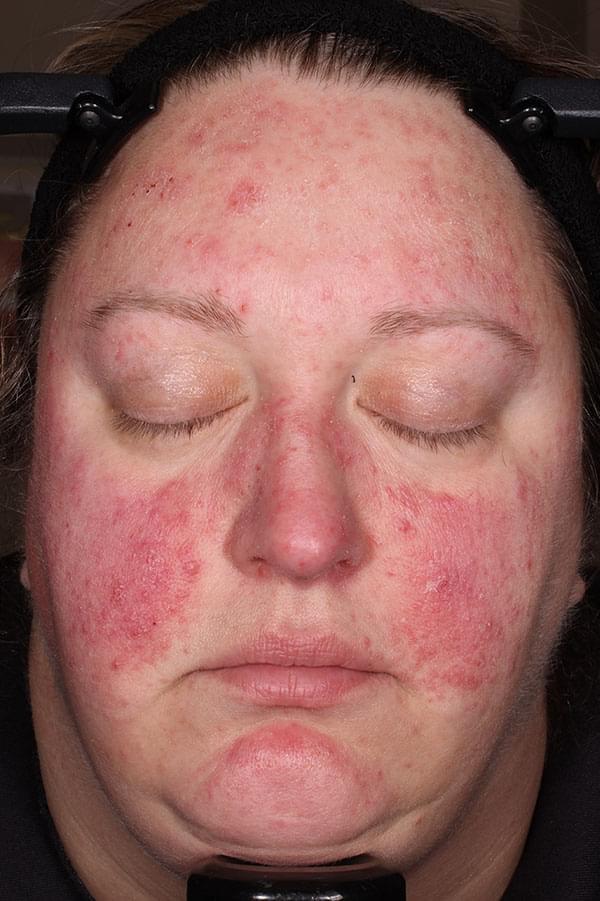 Picture of a female patient with rosacea pre-treatment with Zilxi