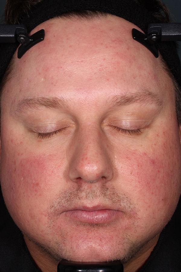 Picture of a male patient with rosacea post-treatment with Zilxi